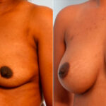 Breast Augmentation before and after photos in Houston, TX, Patient 26088