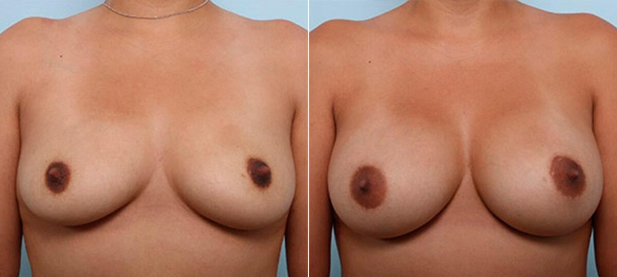 Breast Augmentation before and after photos in Houston, TX, Patient 26099