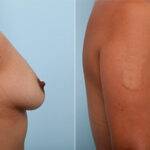 Breast Augmentation before and after photos in Houston, TX, Patient 26099