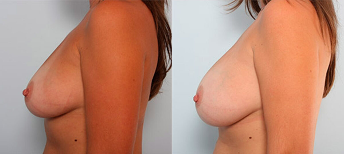 Breast Augmentation before and after photos in Houston, TX, Patient 26110