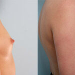 Breast Augmentation before and after photos in Houston, TX, Patient 26121