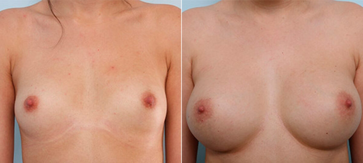 Breast Augmentation before and after photos in Houston, TX, Patient 26121