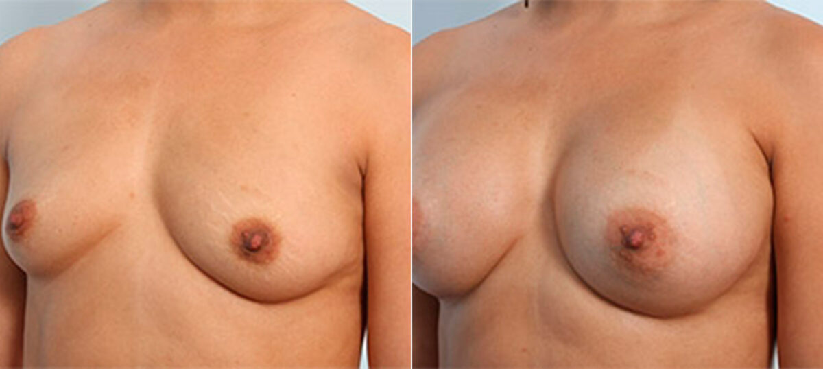Breast Augmentation before and after photos in Houston, TX, Patient 26132