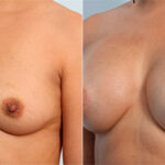 Breast Augmentation before and after photos in Houston, TX, Patient 26132