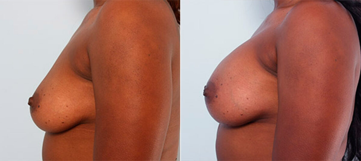 Breast Augmentation before and after photos in Houston, TX, Patient 26143