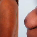Breast Augmentation before and after photos in Houston, TX, Patient 26143