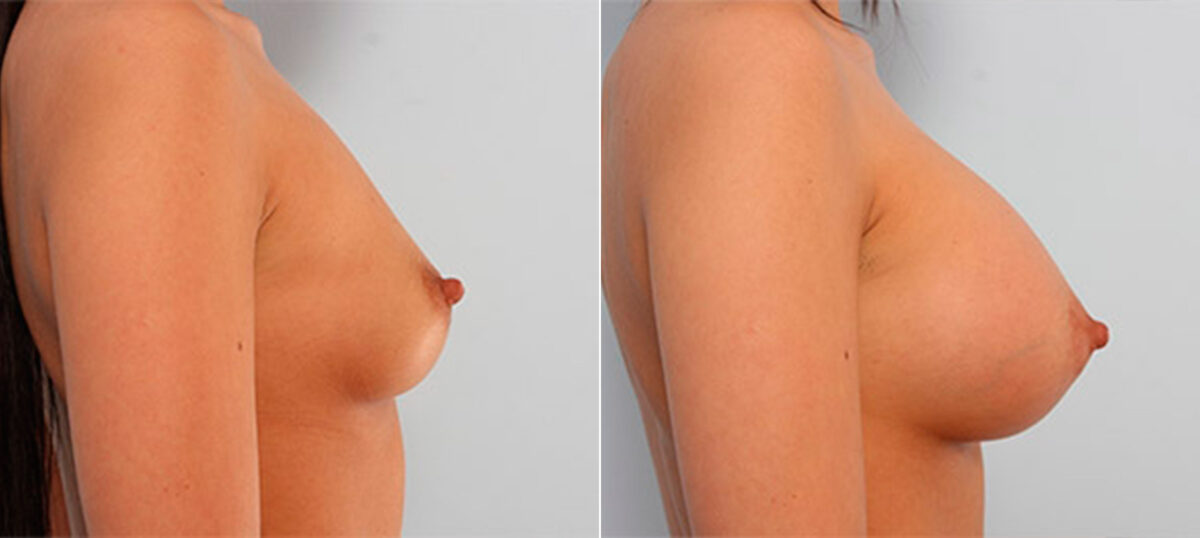 Breast Augmentation before and after photos in Houston, TX, Patient 26154