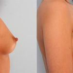 Breast Augmentation before and after photos in Houston, TX, Patient 26154