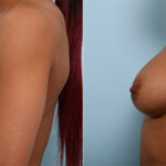 Breast Augmentation before and after photos in Houston, TX, Patient 26165