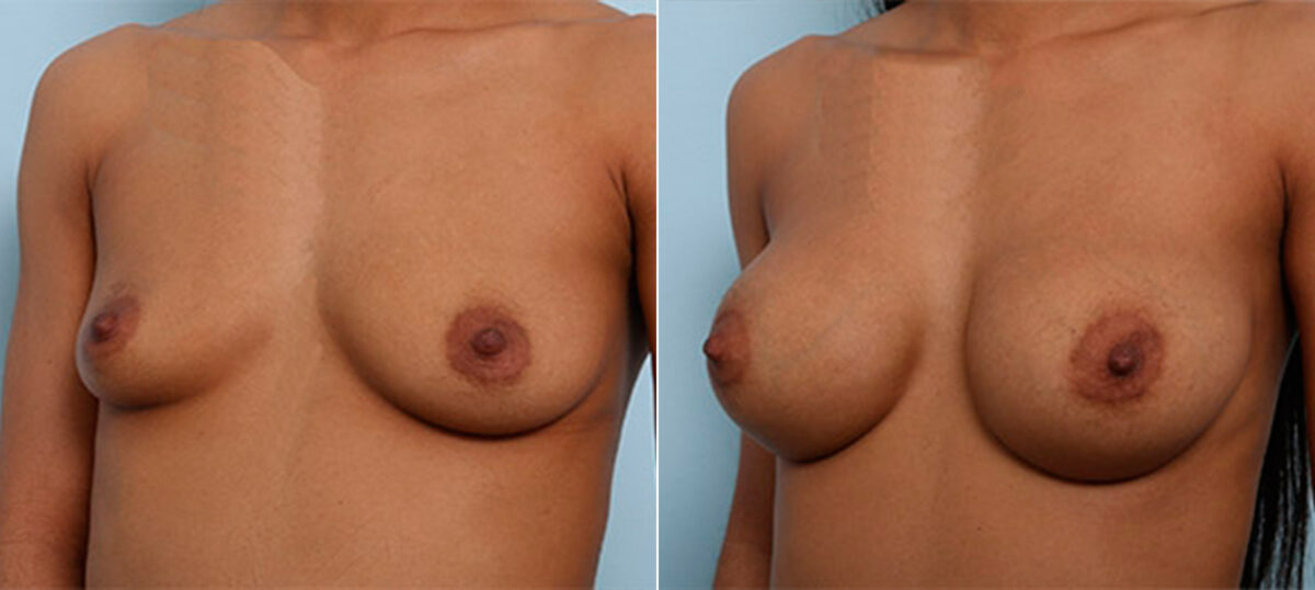 Breast Augmentation before and after photos in Houston, TX, Patient 26165