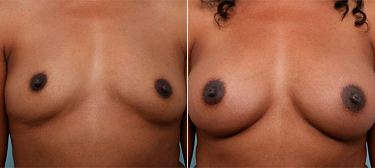 Breast Augmentation before and after photos in Houston, TX, Patient 26176