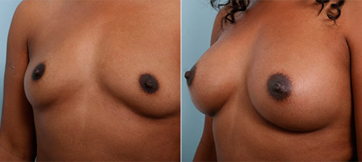 Breast Augmentation before and after photos in Houston, TX, Patient 26176