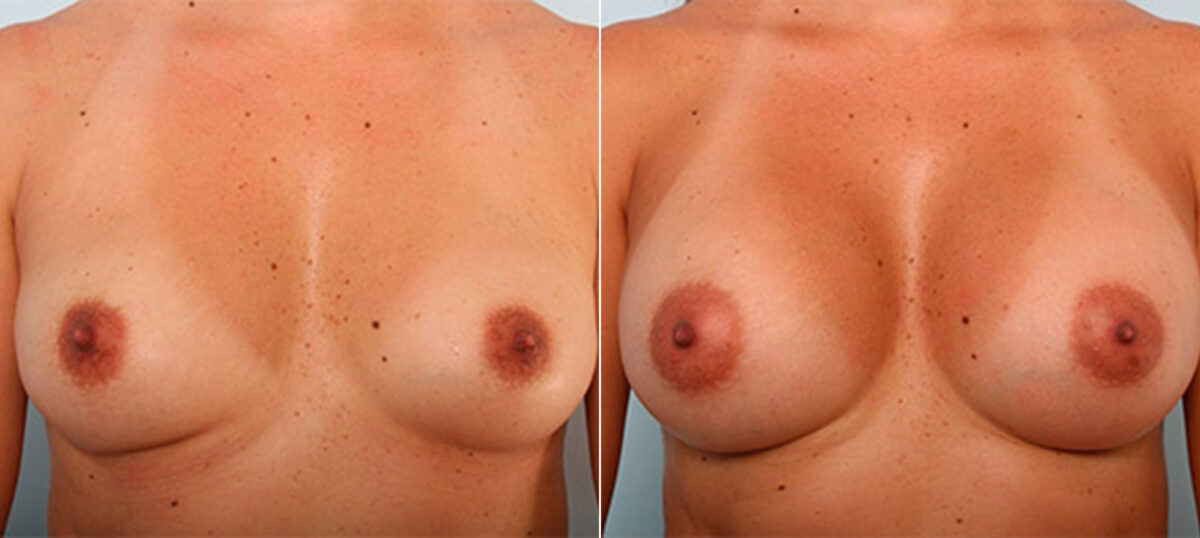 Breast Augmentation before and after photos in Houston, TX, Patient 26187