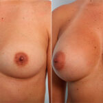 Breast Augmentation before and after photos in Houston, TX, Patient 26187