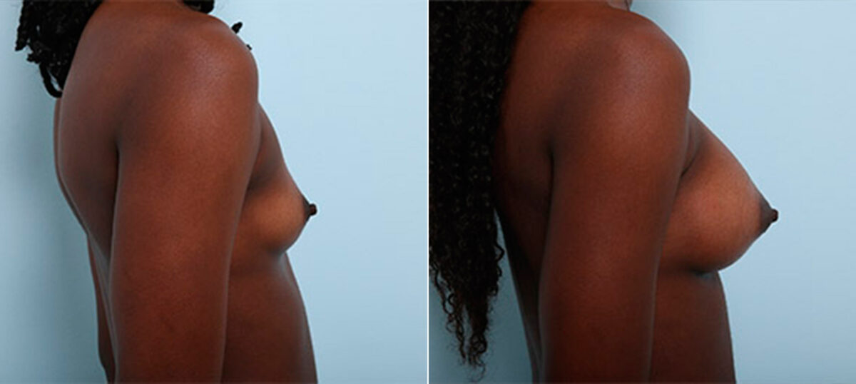 Breast Augmentation before and after photos in Houston, TX, Patient 26198
