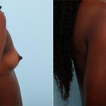 Breast Augmentation before and after photos in Houston, TX, Patient 26198