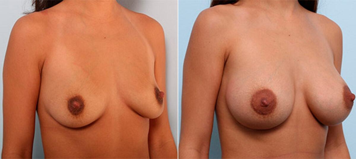 Breast Augmentation before and after photos in Houston, TX, Patient 26207