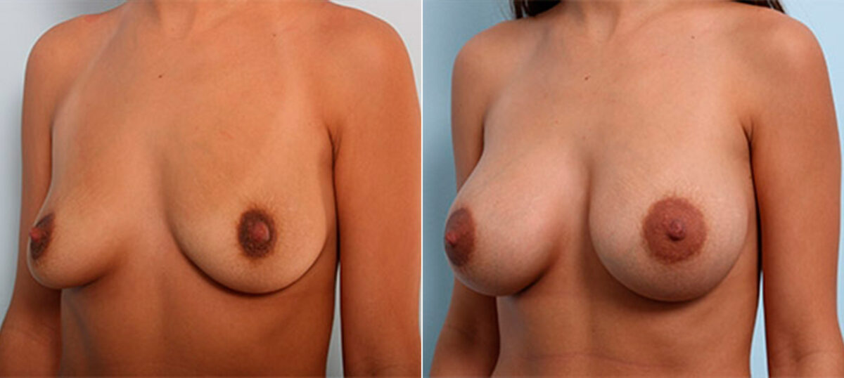 Breast Augmentation before and after photos in Houston, TX, Patient 26207