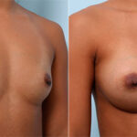 Breast Augmentation before and after photos in Houston, TX, Patient 26218