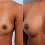 Breast Augmentation before and after photos in Houston, TX, Patient 26218