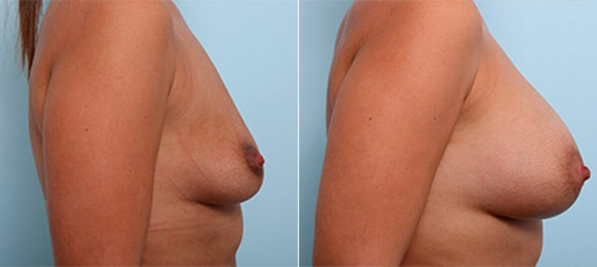 Breast Augmentation before and after photos in Houston, TX, Patient 26229