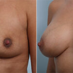 Breast Augmentation before and after photos in Houston, TX, Patient 26229