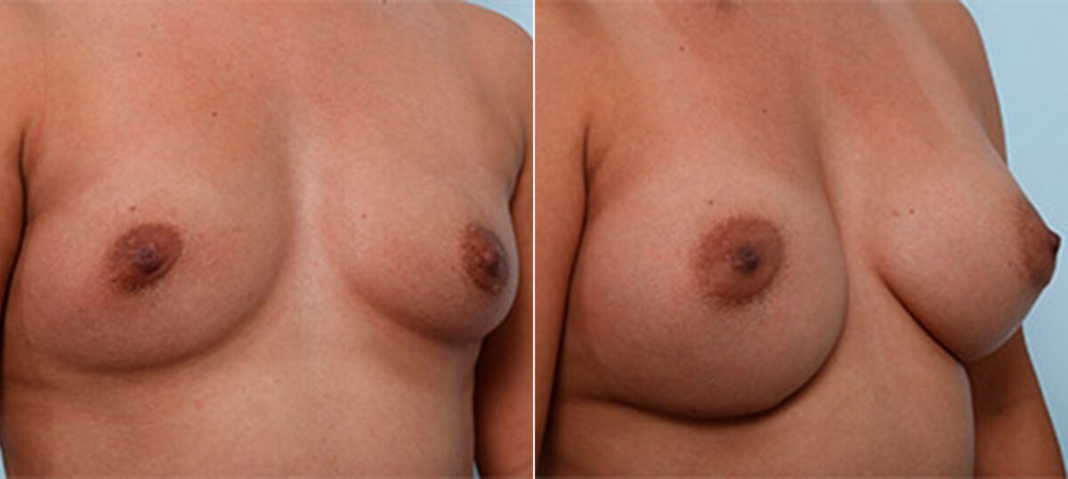 Breast Augmentation before and after photos in Houston, TX, Patient 26240