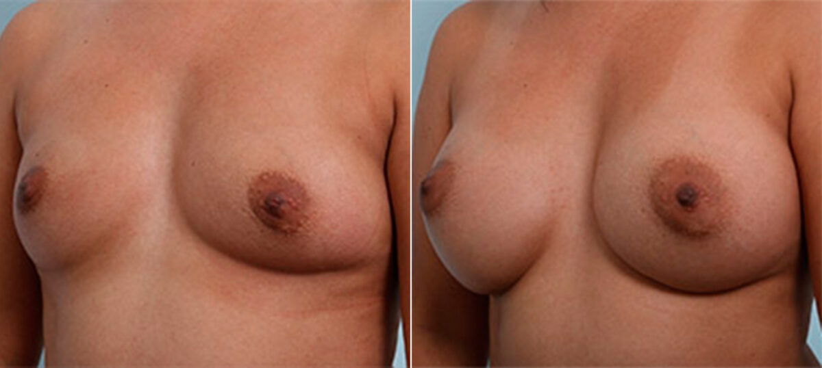 Breast Augmentation before and after photos in Houston, TX, Patient 26240