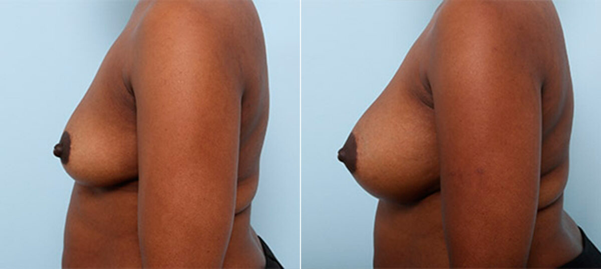 Breast Augmentation before and after photos in Houston, TX, Patient 26251