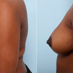 Breast Augmentation before and after photos in Houston, TX, Patient 26251