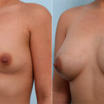 Breast Augmentation before and after photos in Houston, TX, Patient 26262