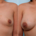 Breast Augmentation before and after photos in Houston, TX, Patient 26262