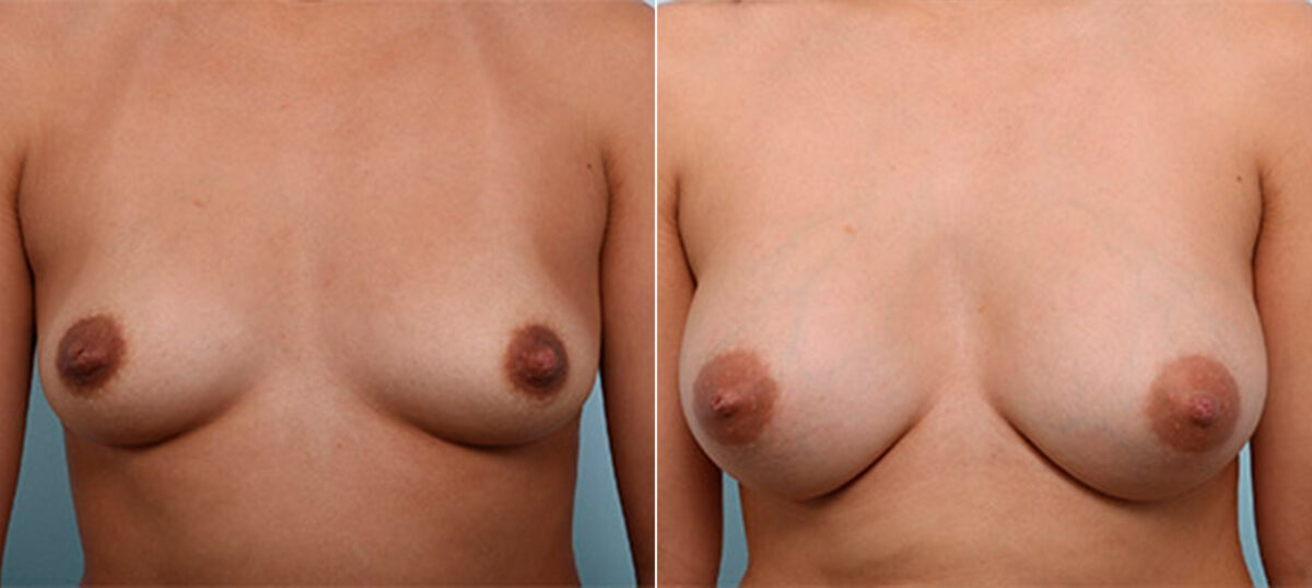 Breast Augmentation before and after photos in Houston, TX, Patient 26273