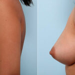 Breast Augmentation before and after photos in Houston, TX, Patient 26273