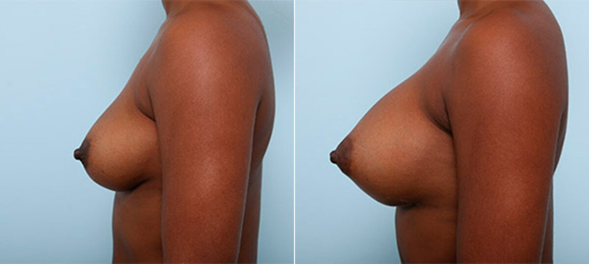 Breast Augmentation before and after photos in Houston, TX, Patient 26284