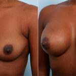 Breast Augmentation before and after photos in Houston, TX, Patient 26284