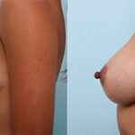 Breast Augmentation before and after photos in Houston, TX, Patient 26295