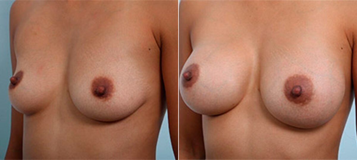 Breast Augmentation before and after photos in Houston, TX, Patient 26295