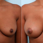 Breast Augmentation before and after photos in Houston, TX, Patient 26306