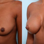 Breast Augmentation before and after photos in Houston, TX, Patient 26306