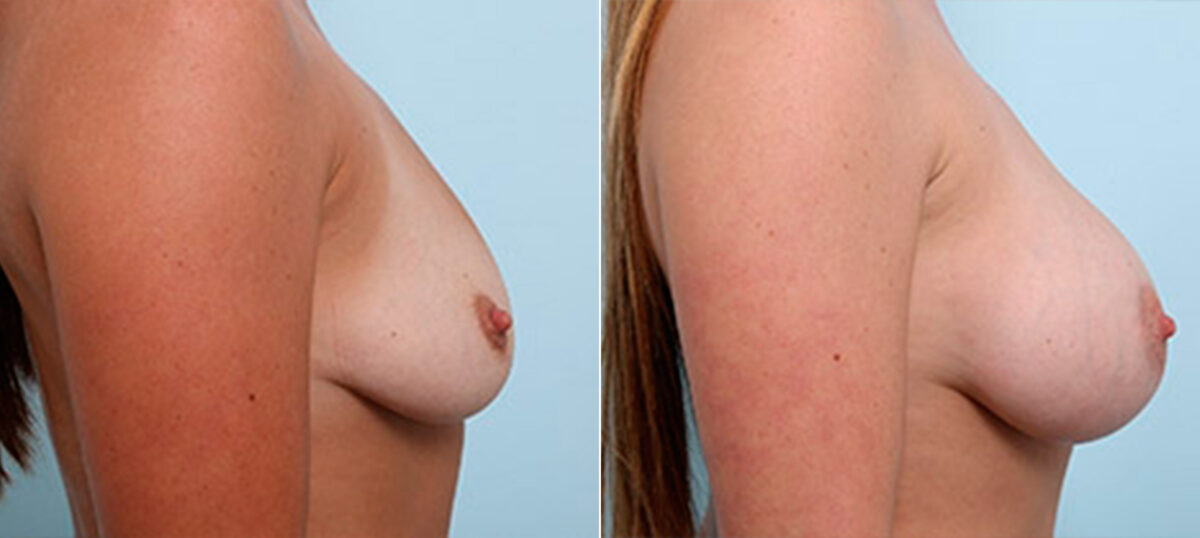Breast Augmentation before and after photos in Houston, TX, Patient 26317
