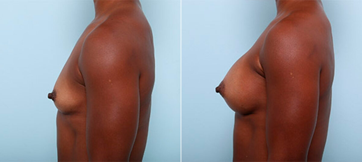 Breast Augmentation before and after photos in Houston, TX, Patient 26328