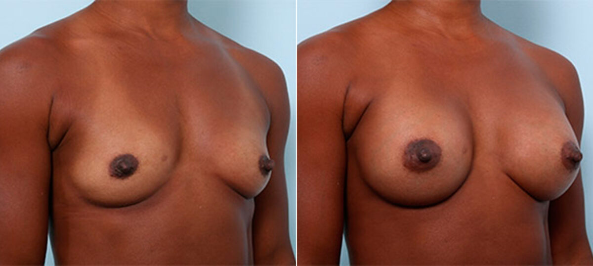 Breast Augmentation before and after photos in Houston, TX, Patient 26328