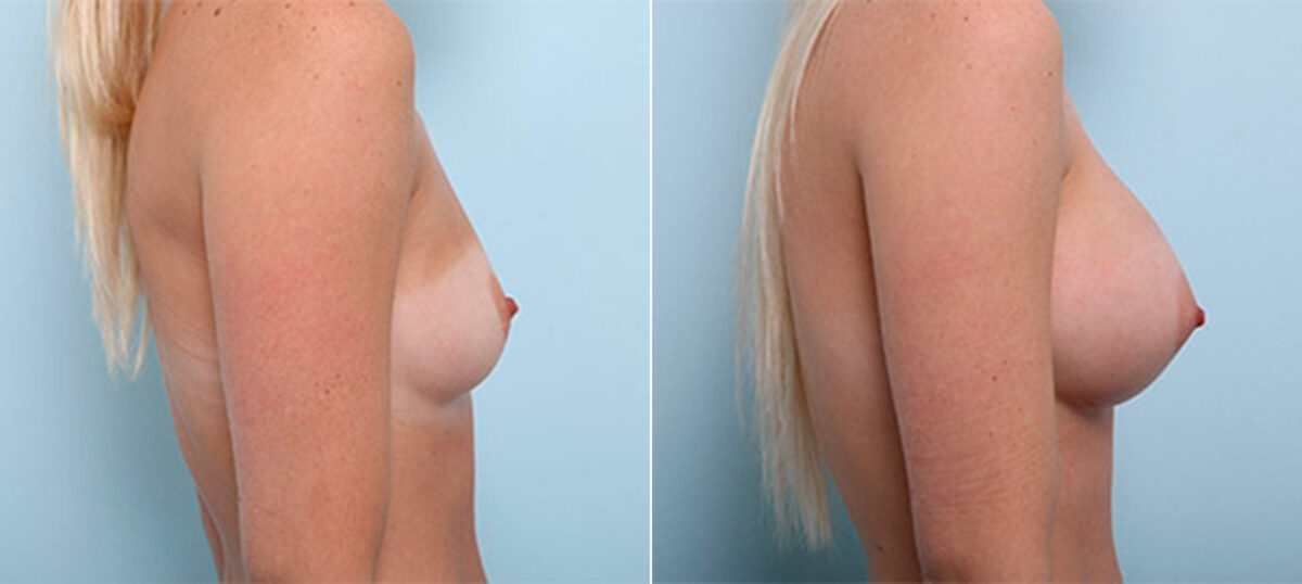 Breast Augmentation before and after photos in Houston, TX, Patient 26339