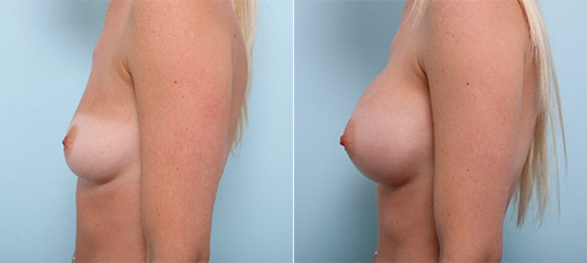 Breast Augmentation before and after photos in Houston, TX, Patient 26339