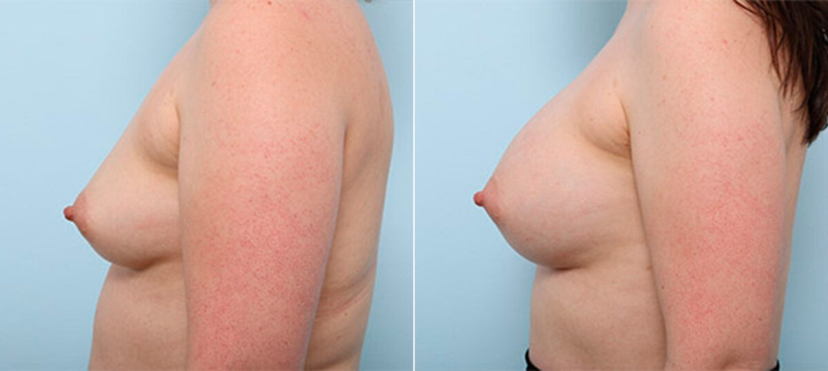 Breast Augmentation before and after photos in Houston, TX, Patient 26350