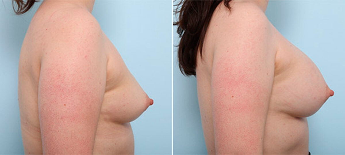Breast Augmentation before and after photos in Houston, TX, Patient 26350