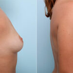 Breast Augmentation before and after photos in Houston, TX, Patient 26361