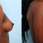Breast Augmentation before and after photos in Houston, TX, Patient 26372