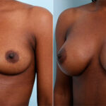 Breast Augmentation before and after photos in Houston, TX, Patient 26372